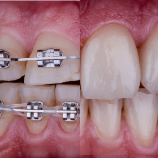 ortodoncija, fasete, krunice, Dejan - ortodoncija, fasete, krunice