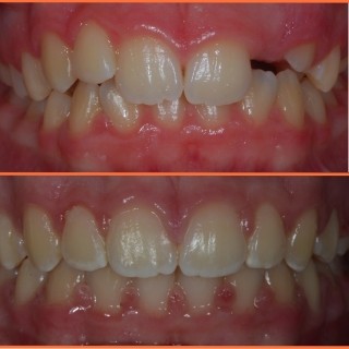 Impakcija zuba - ortodoncija