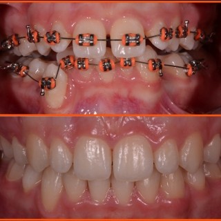 teskoba: nedostatak prostora u zubnom nizu - ortodoncija
